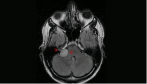 Neurinoma del Acústico