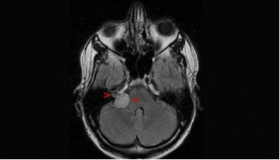 Neurinoma del Acústico